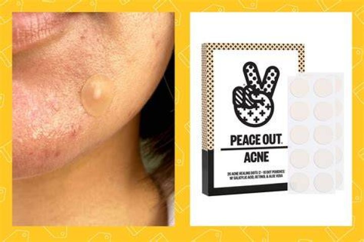 The Cutest Pimple Patches to Combat Acne